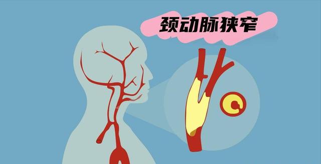 男子血管狭窄75%,2年后恢复通畅,他的7个习惯值得借鉴